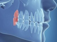 Зубы мудрости: возможные проблемы и избавление от них