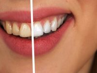 5 способов привести зубы в порядок