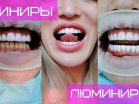 Люминиры – модерновая технология реставрации зубов